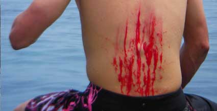 Surfing Accident, Reef Carnage, Reef Cuts, Surfing injuries, Reef Scars, Surf Scars